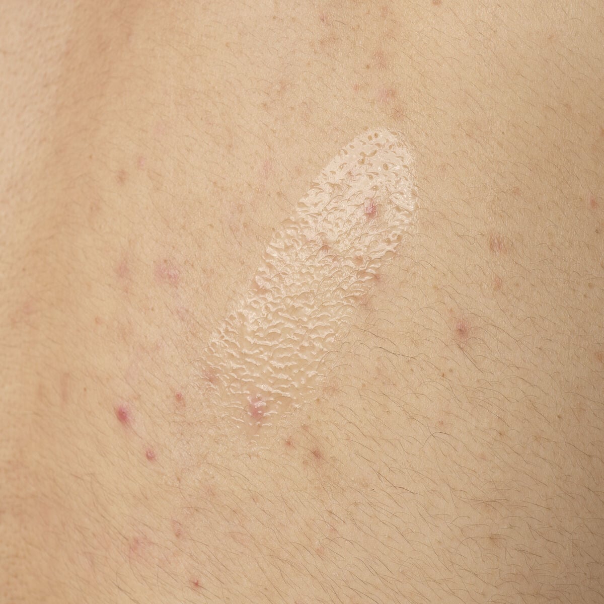 salicylic-acid-0-5-body-serum-w9 ORD-salicylic-acid-05-body-240ml-application.jpg