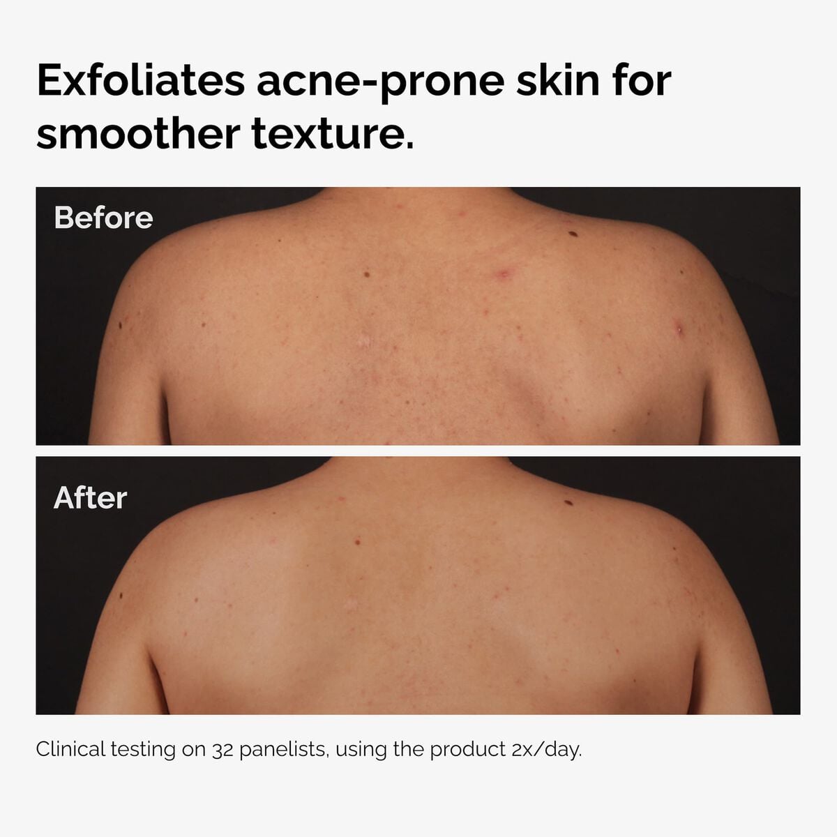salicylic-acid-0-5-body-serum-w9 ord-salicylic-acid-body-serum-before-after-graphic-NA.jpg